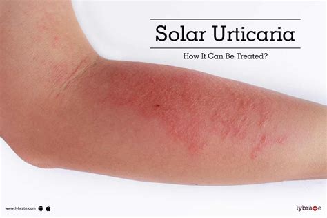 urticaria can be treated with